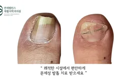 연세밸런스 | 문제성 발톱 관리는 어디서 ?